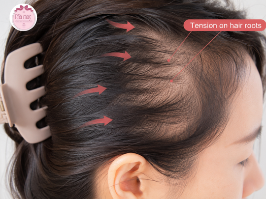 A close-up shot of a woman's scalp where hair is pulled tightly by a claw clip, showing tensio...png