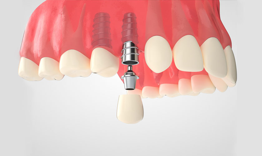 cay-implant.jpg