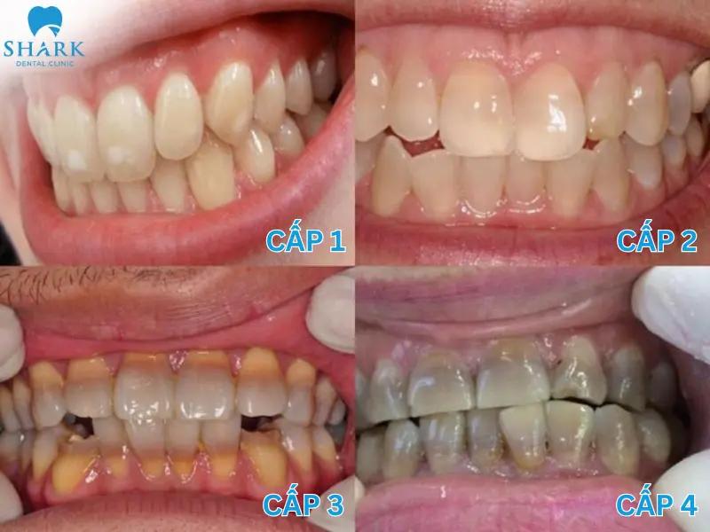 Các cấp răng nhiễm Tetracycline