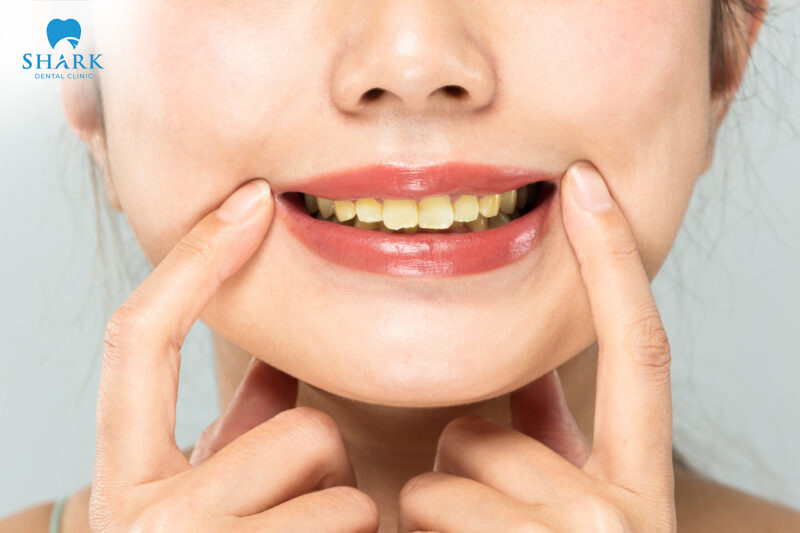 Đánh răng thường xuyên nhưng vẫn vào răng