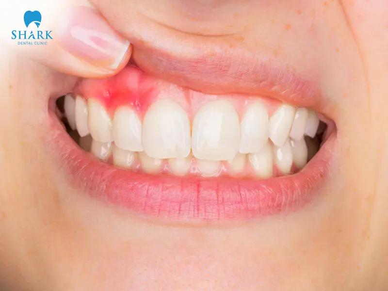 tẩy trắng răng bị bỏng nướu