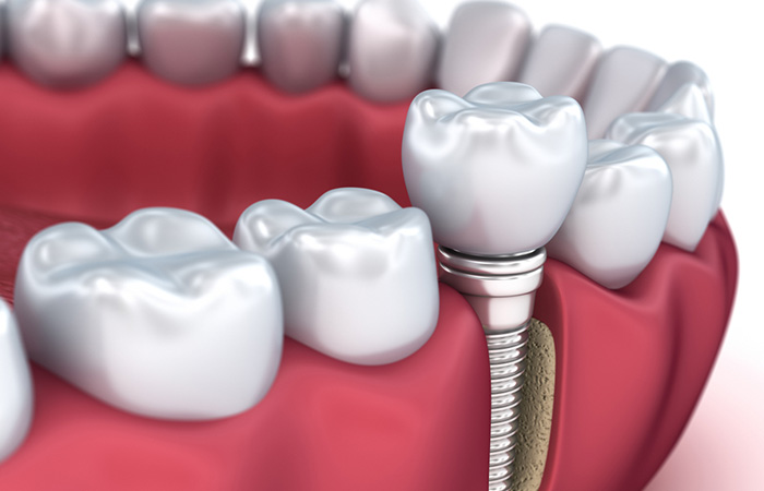 trong-rang-implant.jpg